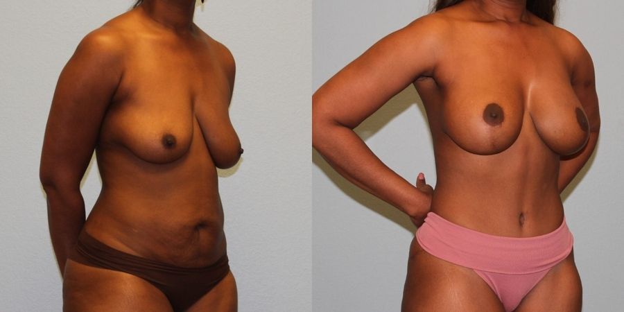 Breast Augmentation with Lift - Thumbnail 2