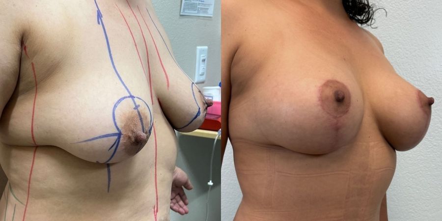 Breast Augmentation with Lift - Thumbnail 2