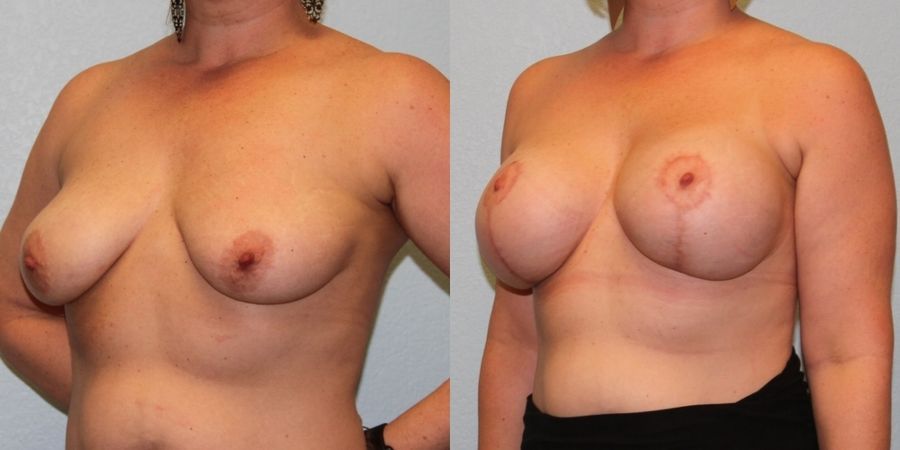 Breast Augmentation with Lift - Thumbnail 2