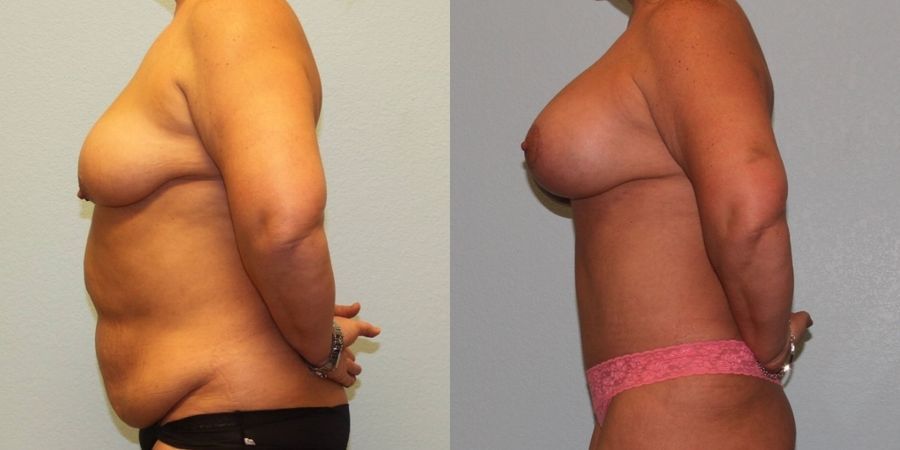 Breast Augmentation with Lift - Thumbnail 3