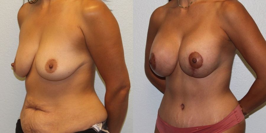 Breast Augmentation with Lift - Thumbnail 2