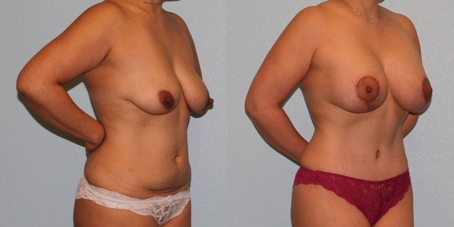 Breast Augmentation with Lift - Thumbnail 2