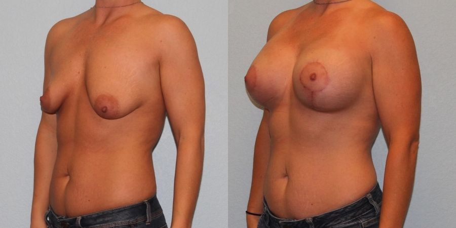Breast Augmentation with Lift - Thumbnail 2