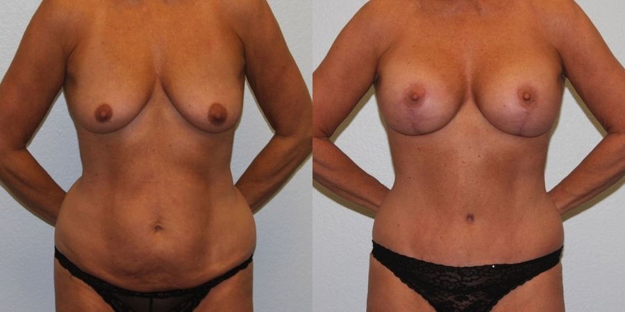 Breast Augmentation with Lift - Case 19368