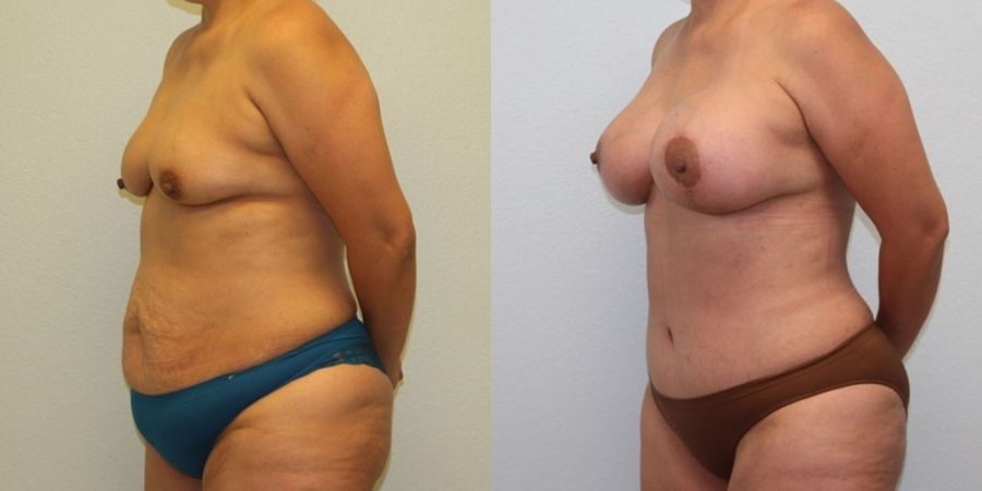 Breast Augmentation with Lift - Thumbnail 2