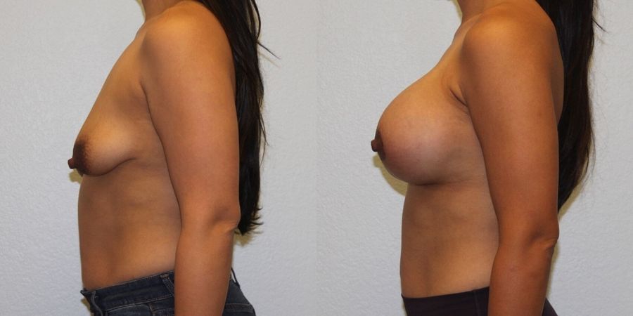 Breast Augmentation with Lift - Thumbnail 3