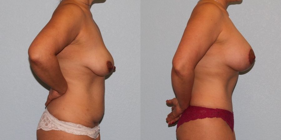 Breast Augmentation with Lift - Thumbnail 3