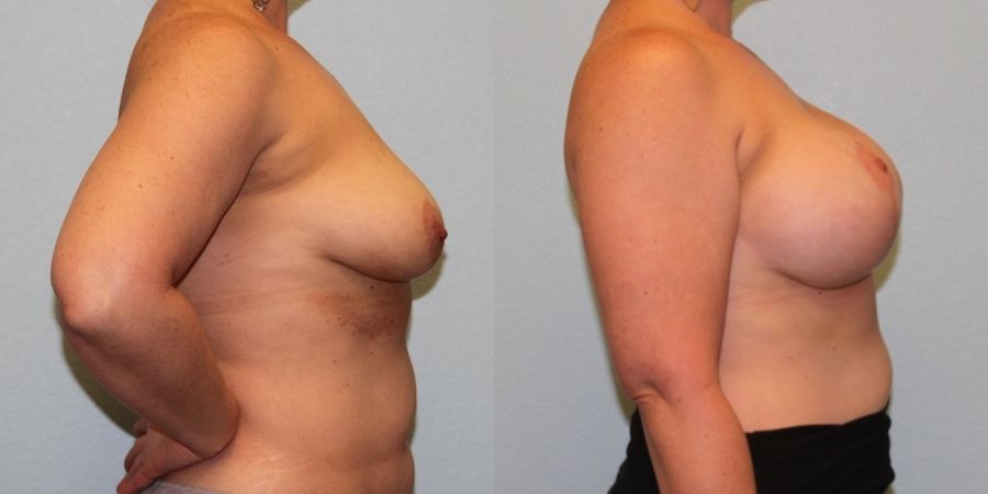 Breast Augmentation with Lift - Thumbnail 3