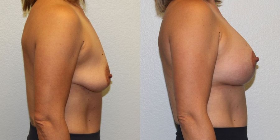Breast Augmentation with Lift - Thumbnail 3