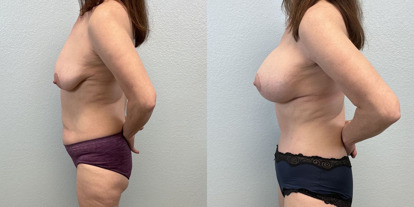 Breast Augmentation with Lift - Thumbnail 3