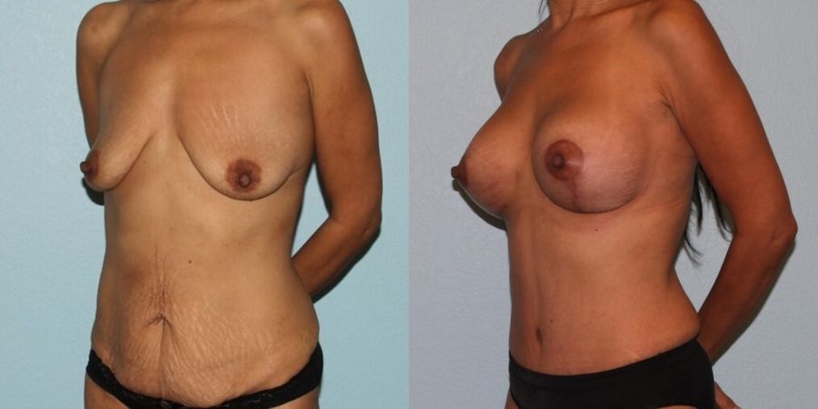 Breast Augmentation with Lift - Thumbnail 2