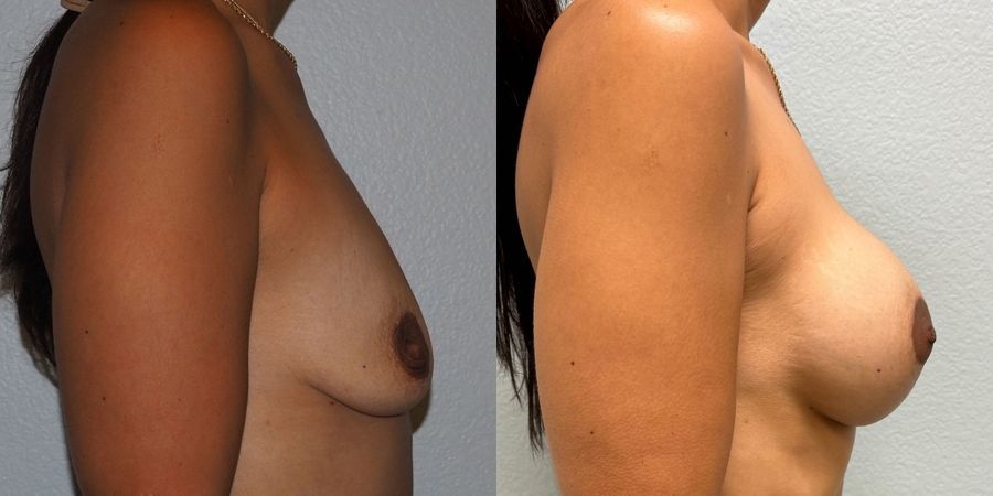 Breast Augmentation with Lift - Thumbnail 2