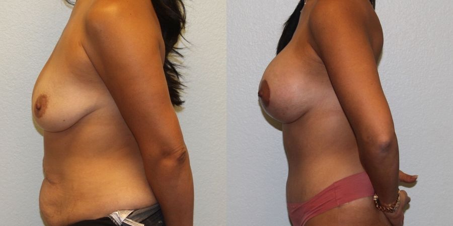 Breast Augmentation with Lift - Thumbnail 3