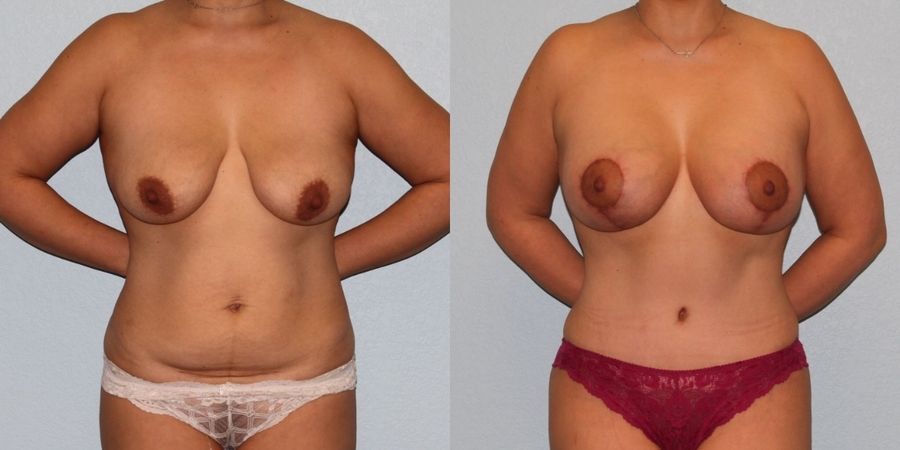 Breast Augmentation with Lift - Case 19365