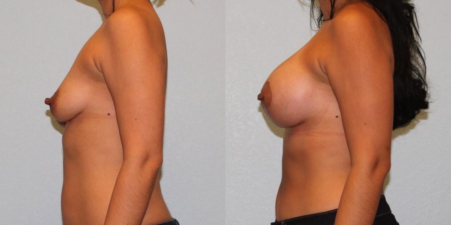 Breast Augmentation with Lift - Thumbnail 3