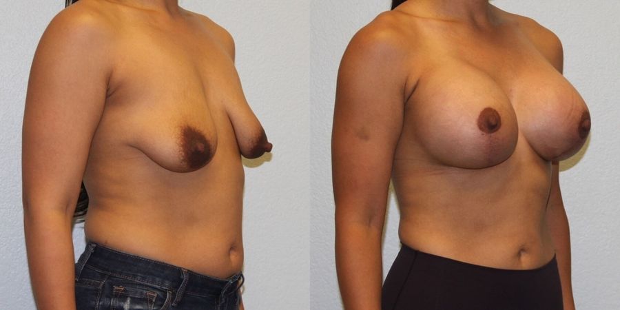 Breast Augmentation with Lift - Thumbnail 2
