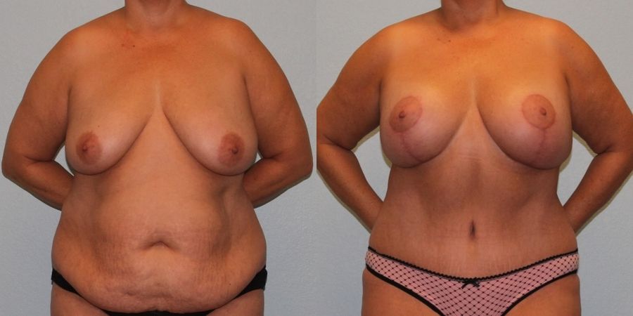 Breast Augmentation with Lift - Case 19370