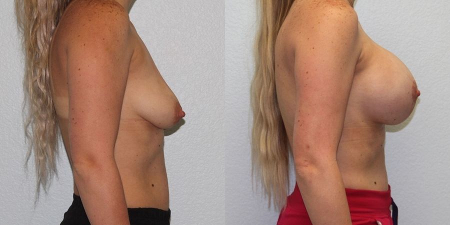 Breast Augmentation with Lift - Thumbnail 3