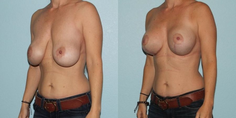 Breast Augmentation with Lift - Thumbnail 2
