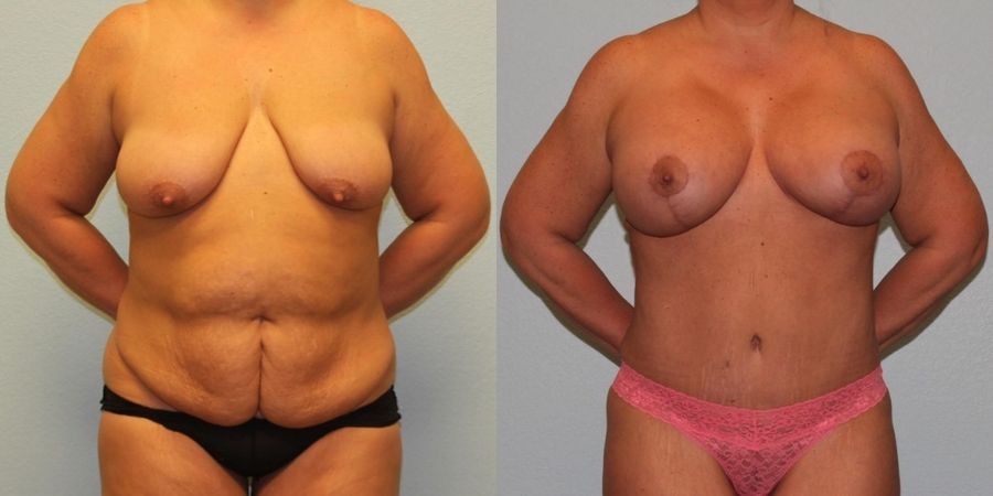 Breast Augmentation with Lift - Case 19369