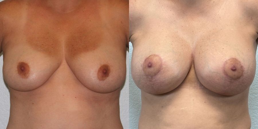 Breast Augmentation with Lift - Case 19377