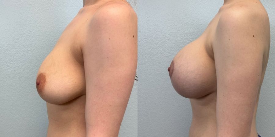 Breast Augmentation with Lift - Thumbnail 3