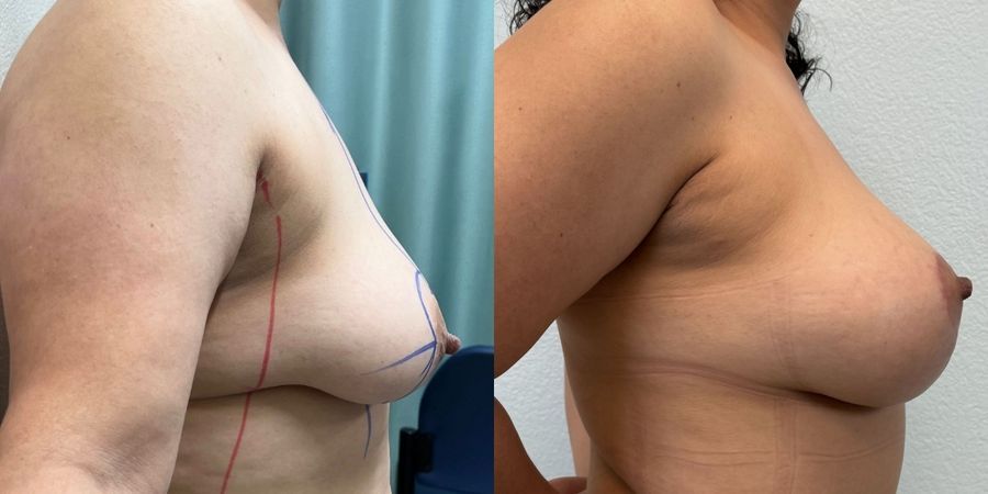 Breast Augmentation with Lift - Thumbnail 3