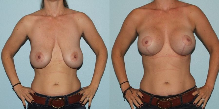 Breast Augmentation with Lift - Case 19374