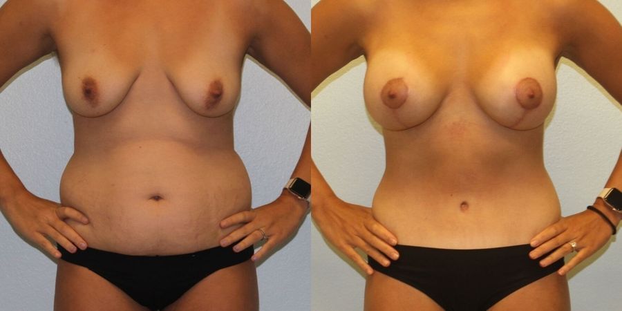 Breast Augmentation with Lift - Case 19357