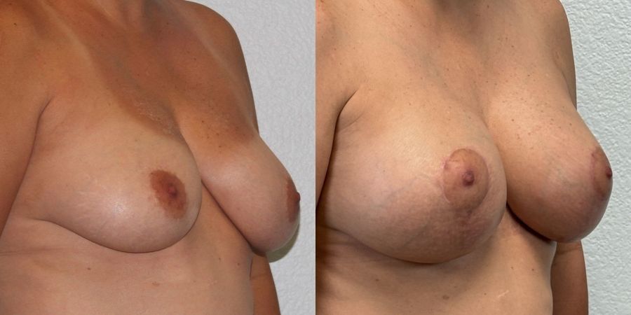 Breast Augmentation with Lift - Thumbnail 2