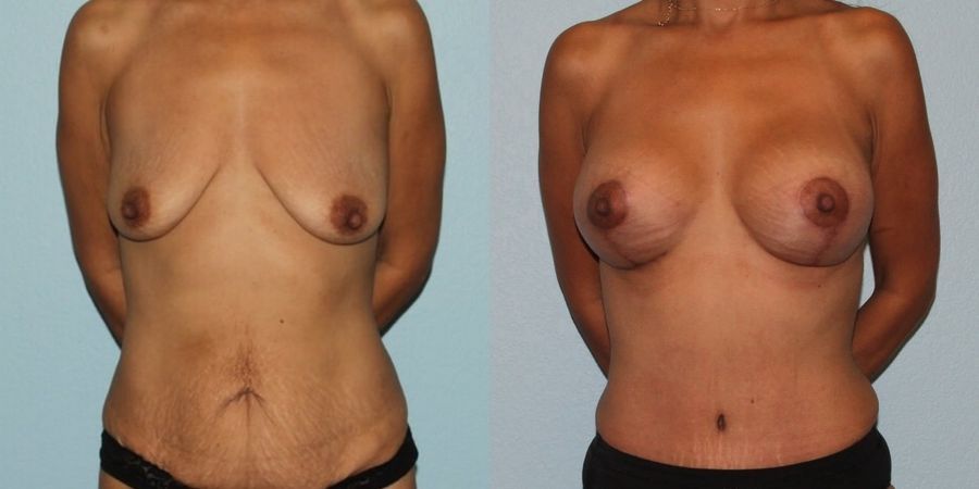 Breast Augmentation with Lift - Case 19367