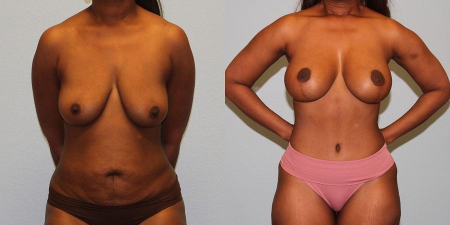 Breast Augmentation with Lift - Case 19375