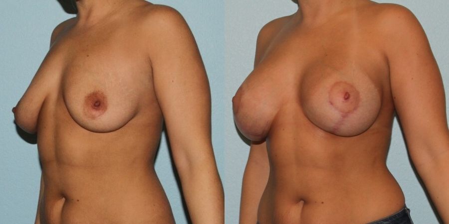 Breast Augmentation with Lift - Thumbnail 2