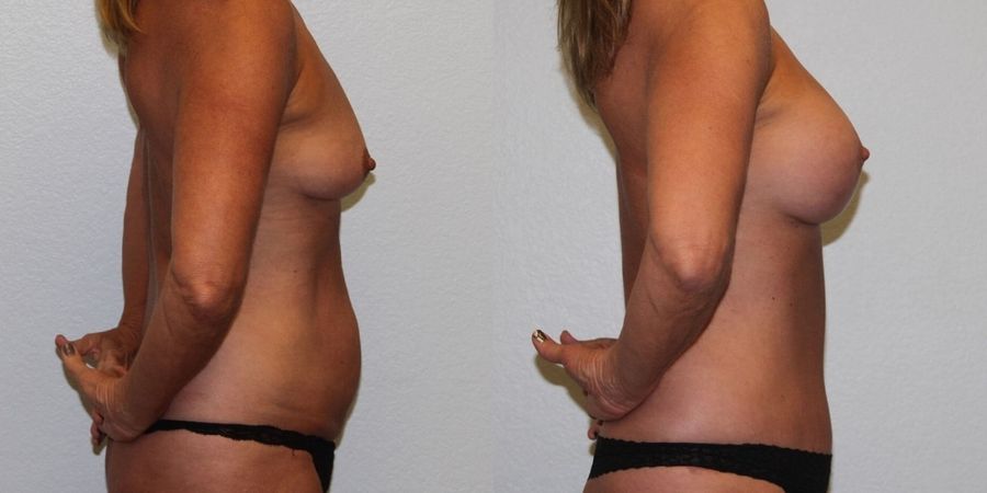 Breast Augmentation with Lift - Thumbnail 3