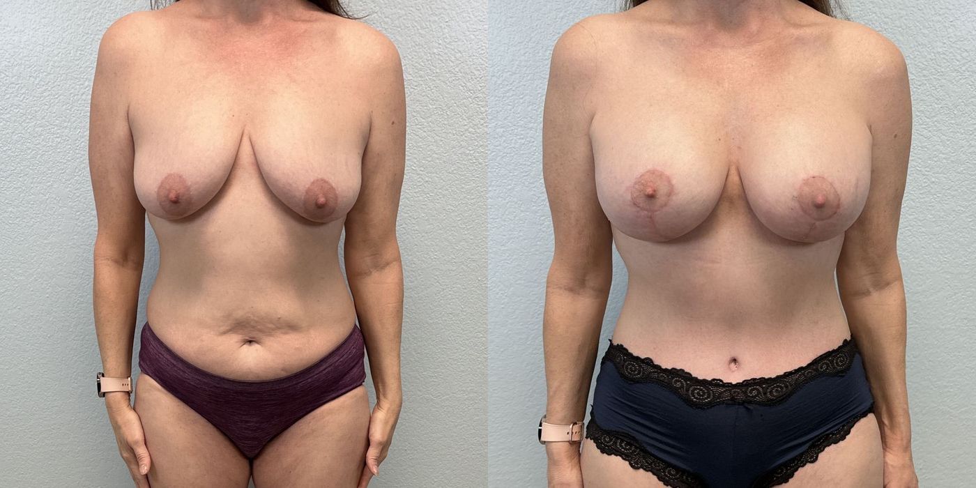 Breast Augmentation with Lift - Case 19381