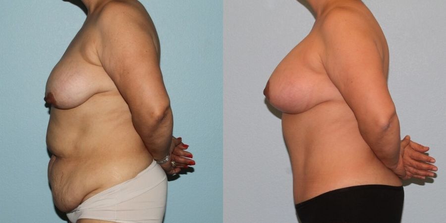 Breast Augmentation with Lift - Thumbnail 3