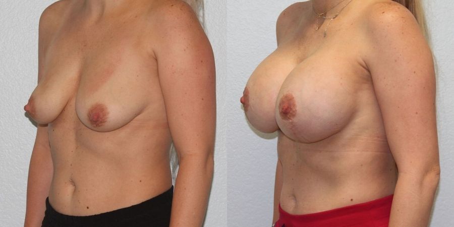 Breast Lift - Thumbnail 2