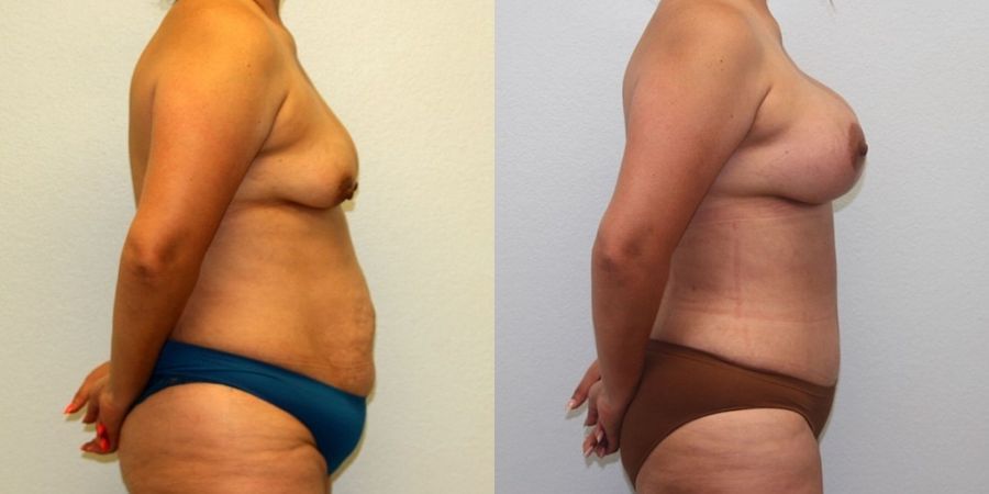 Breast Lift - Thumbnail 3