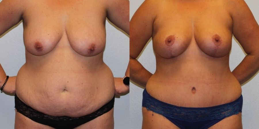 Breast Lift - Case 19399