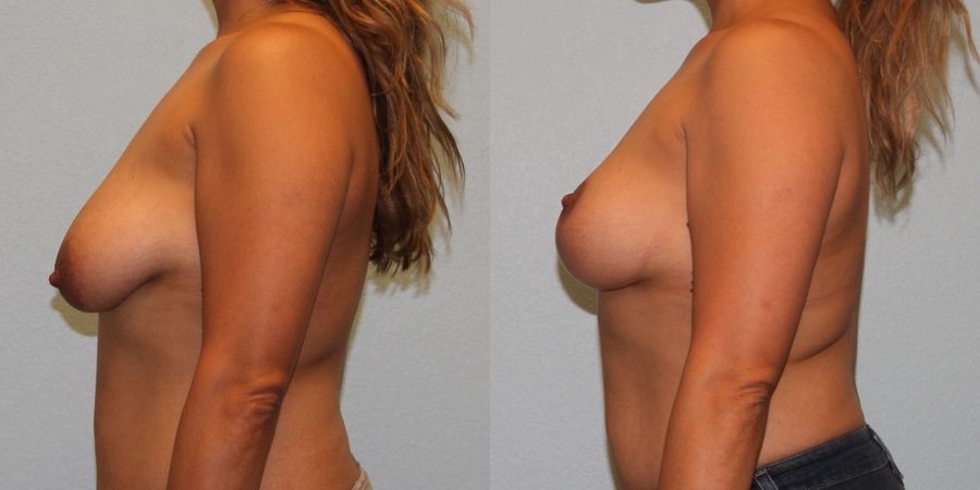 Breast Lift - Thumbnail 3