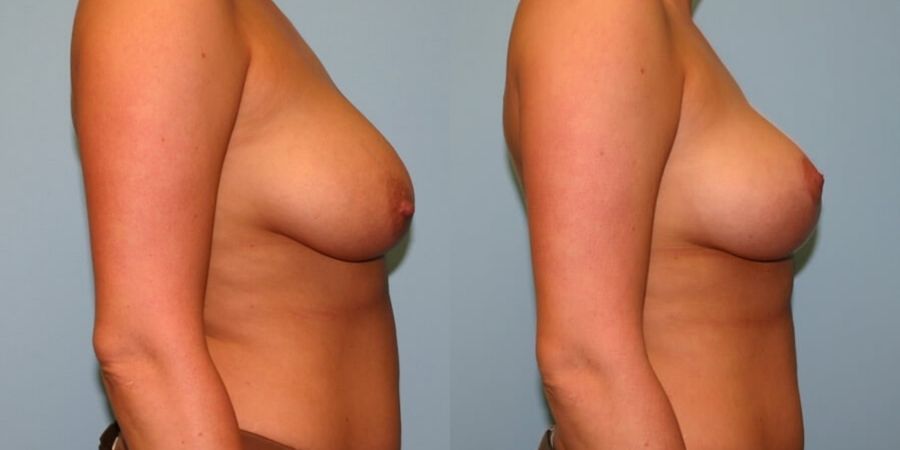 Breast Lift - Thumbnail 2