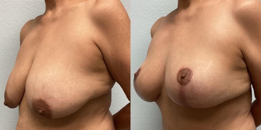 Breast Lift - Thumbnail 2
