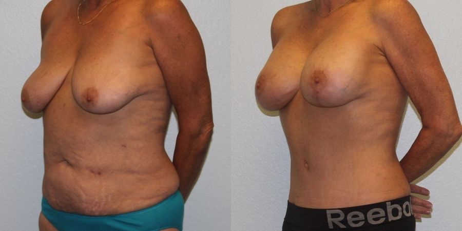 Breast Lift - Thumbnail 2