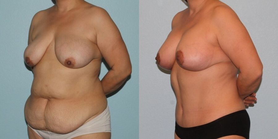 Breast Lift - Thumbnail 2