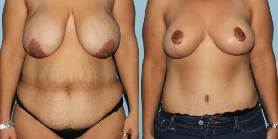 Breast Lift - Case 19400