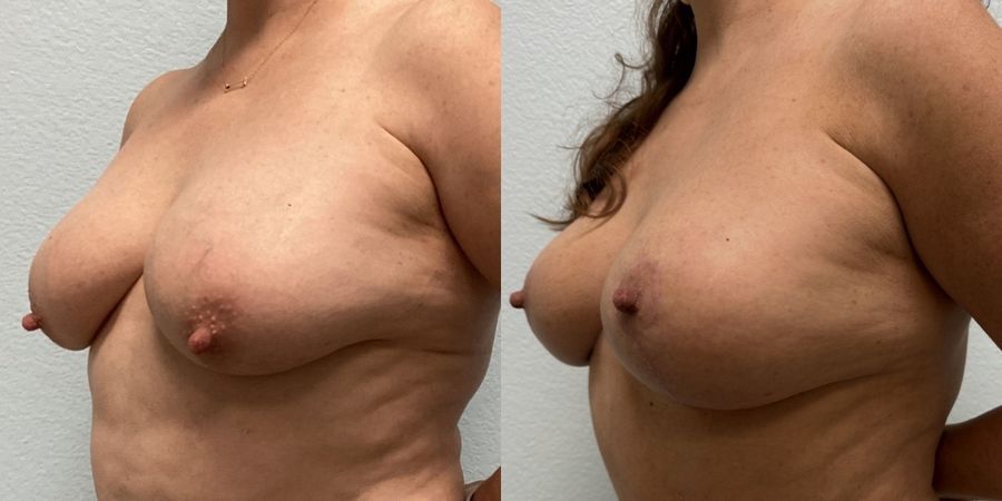 Breast Lift - Thumbnail 2