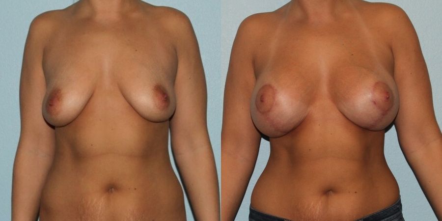 Breast Lift - Case 19404