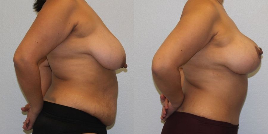 Breast Lift - Thumbnail 3