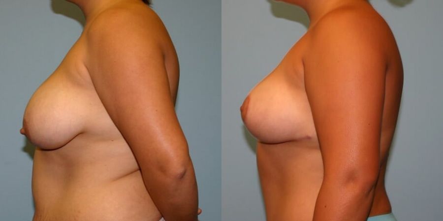 Breast Lift - Thumbnail 3
