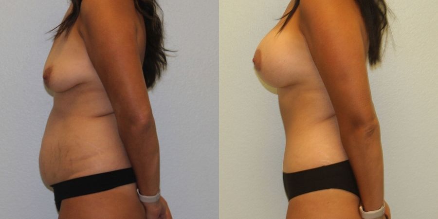 Breast Lift - Thumbnail 3